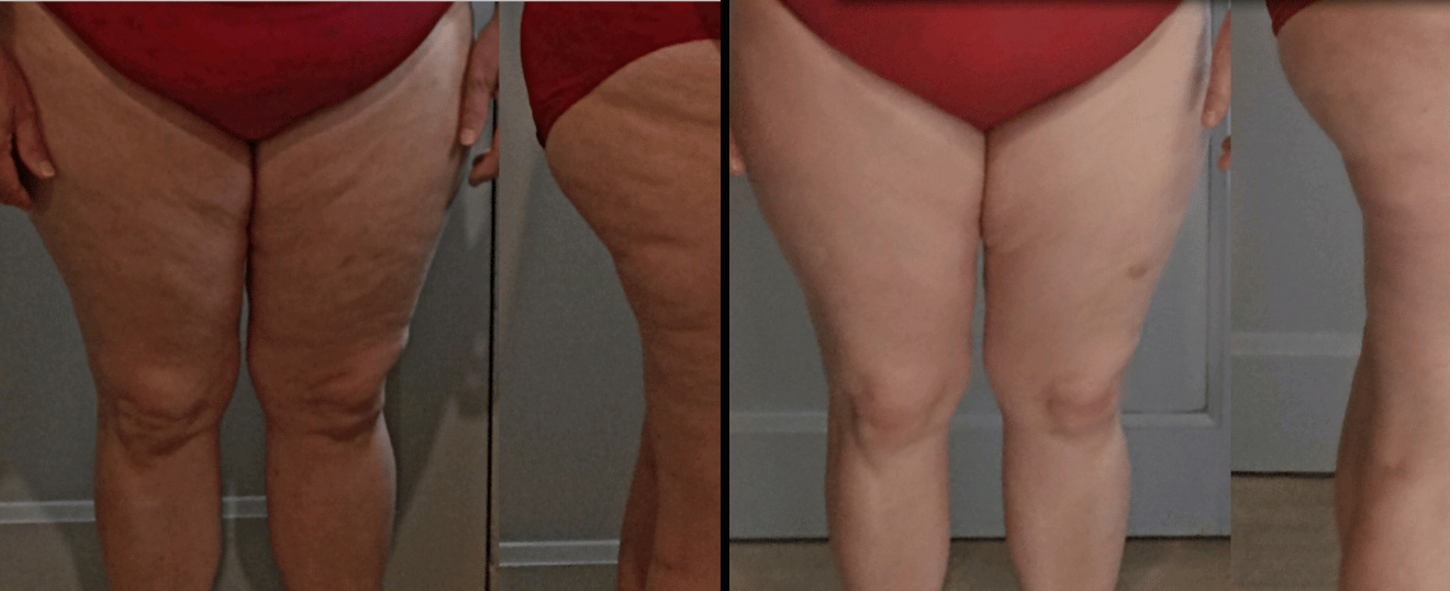 Avant / Après : les résultats visibles des séances minceur LoéZen